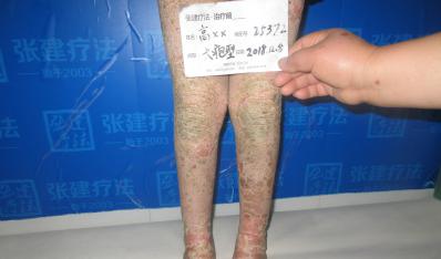 “你給了我第二次生命”魚鱗幼童重獲新生