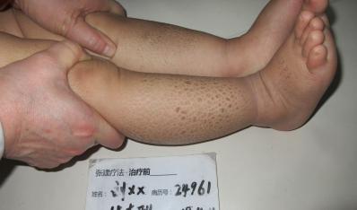 微信群里巧遇病友，意外治好多年魚鱗病