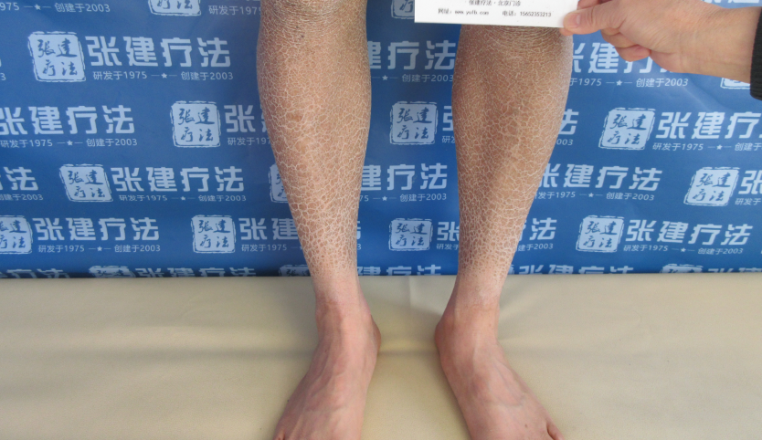 魚(yú)鱗皮膚病