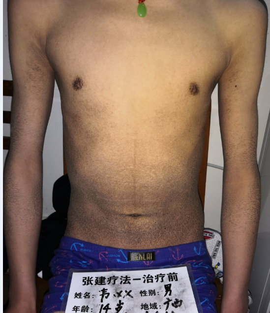 魚鱗皮膚治療前