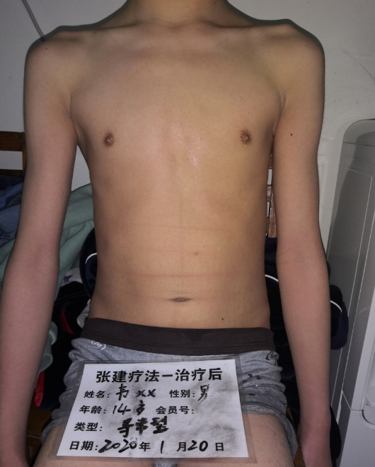 魚鱗皮膚治療后