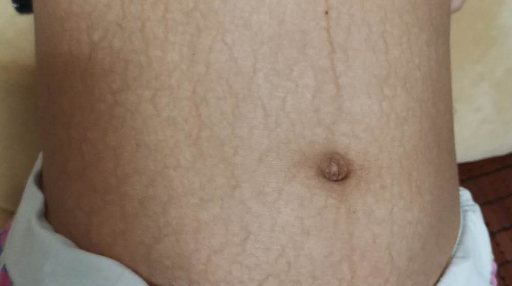 幼兒魚鱗皮膚病