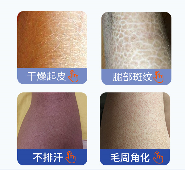魚鱗皮膚怎么治