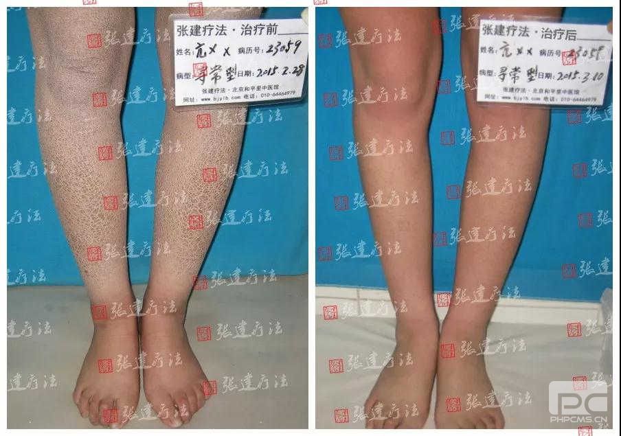 魚鱗皮膚怎么治