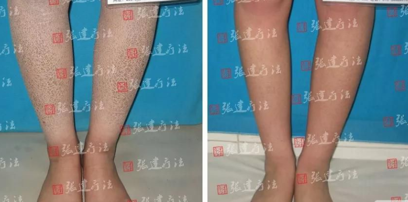 皮膚干燥像雪花怎么辦